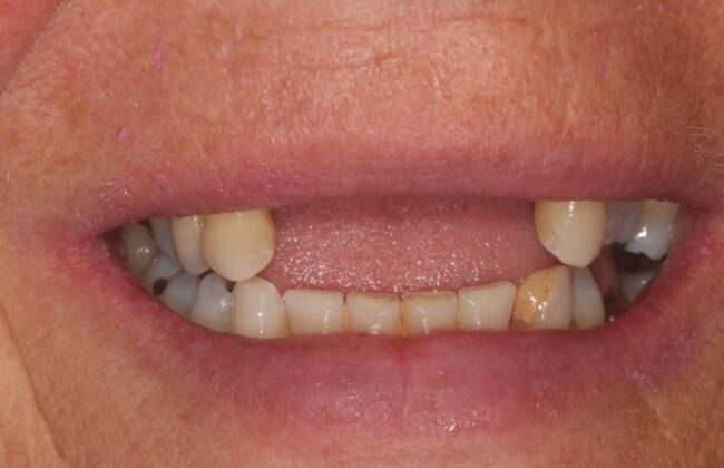 Before (Teeth)