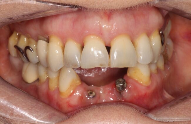 Before (Teeth)