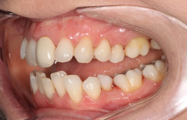 Before (Teeth)