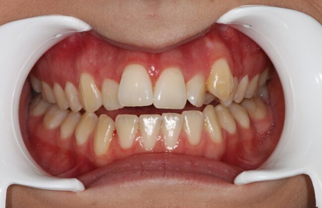 Before (Teeth)