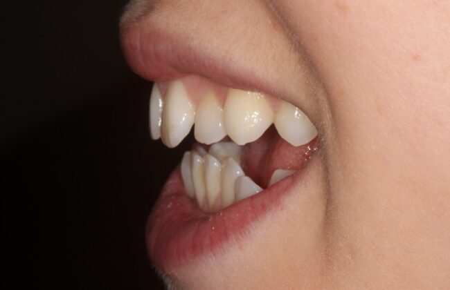 Before (Teeth)