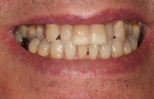 Before (Teeth)