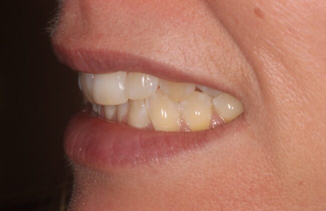 Before (Teeth)