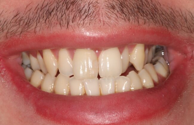 Before (Teeth)