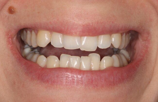 Before (Teeth)