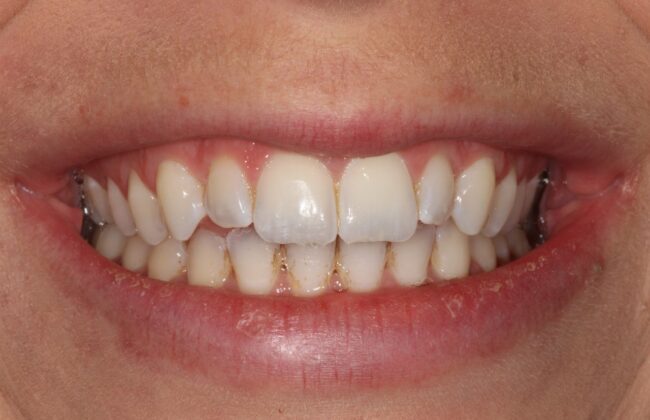 Before (Teeth)