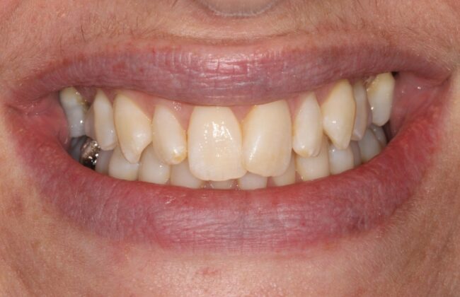 Before (Teeth)