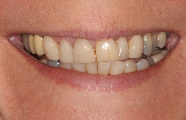 Before (Teeth)