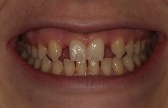 Before (Teeth)