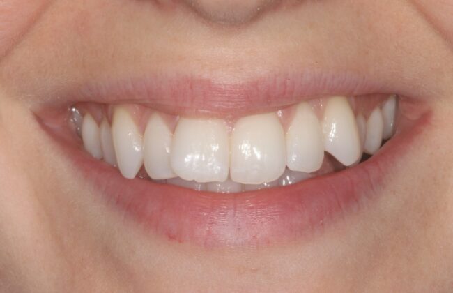 Before (Teeth)