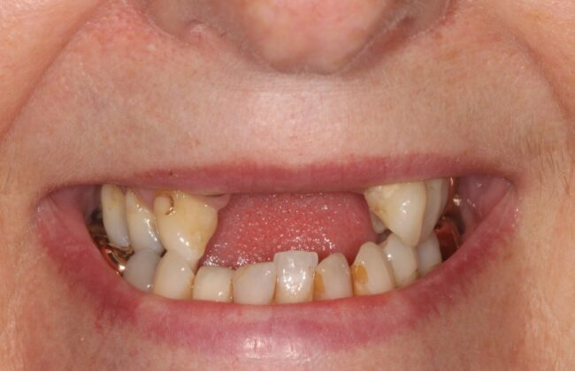 Before (Teeth)
