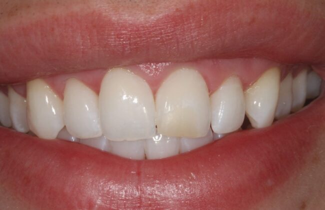 Before (Teeth)