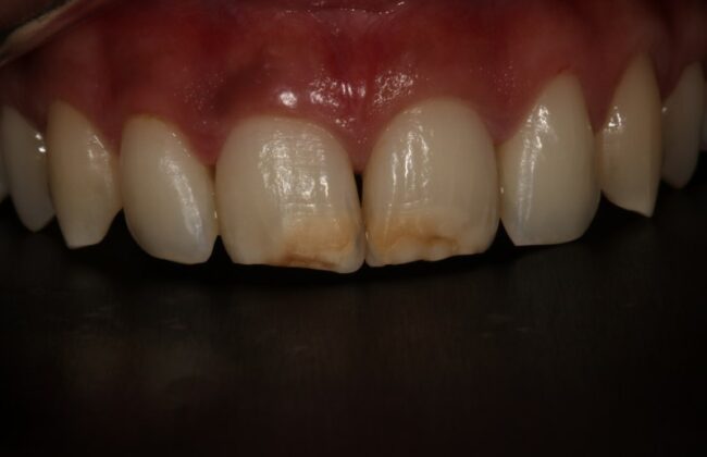 Before (Teeth)