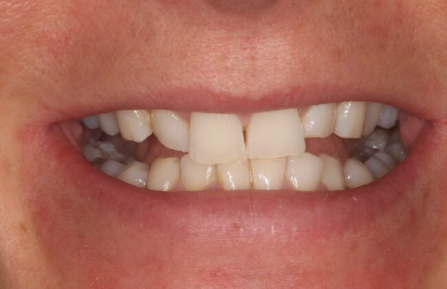 Before (Teeth)