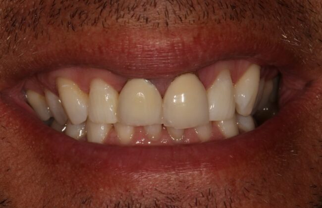 Before (Teeth)