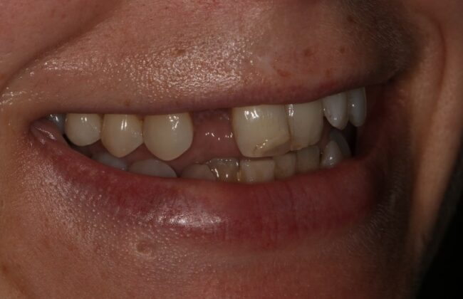 Before (Teeth)