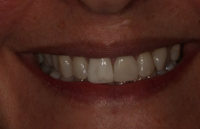 Before (Teeth)