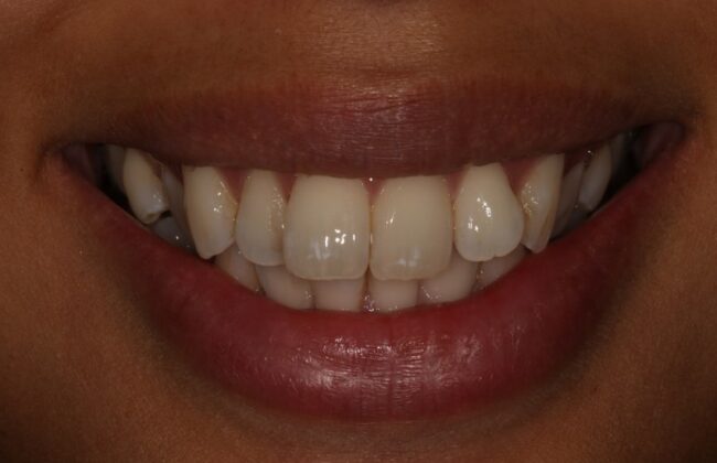 Before (Teeth)