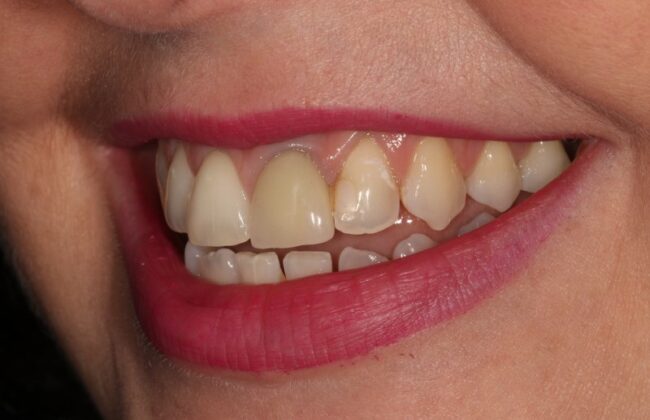 Before (Teeth)