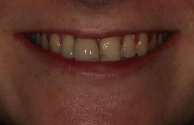 Before (Teeth)