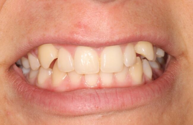 Before (Teeth)