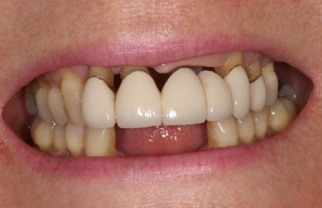 Before (Teeth)