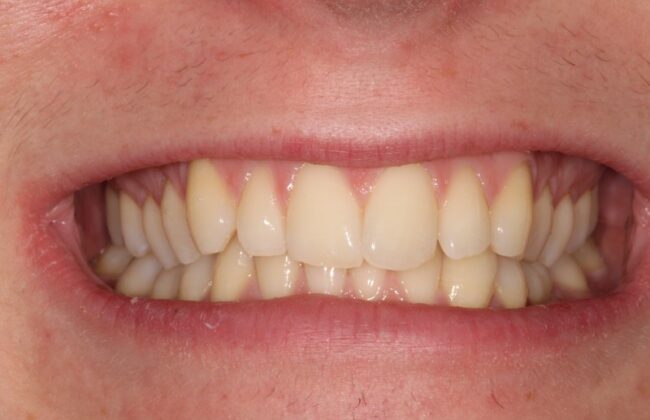 Before (Teeth)