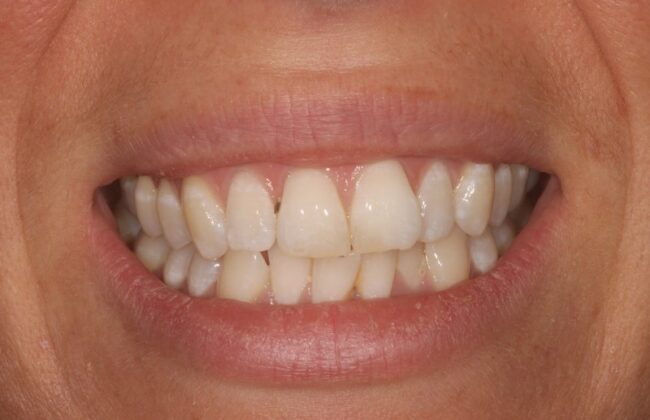Before (Teeth)