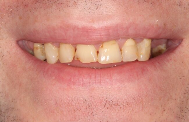 Before (Teeth)