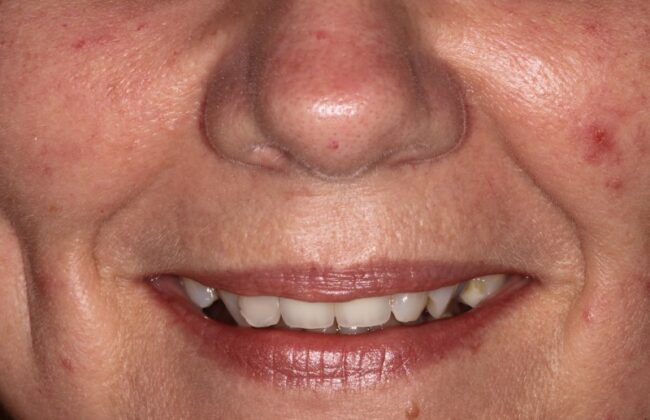 Before (Teeth)
