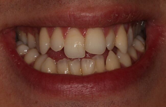 Before (Teeth)