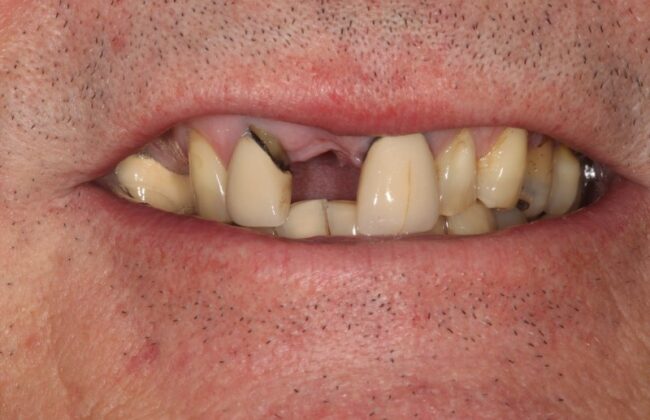 Before (Teeth)