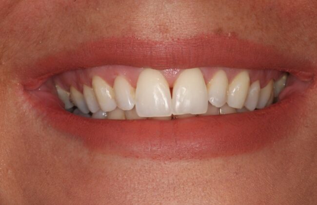 Before (Teeth)