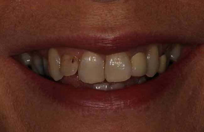 Before (Teeth)