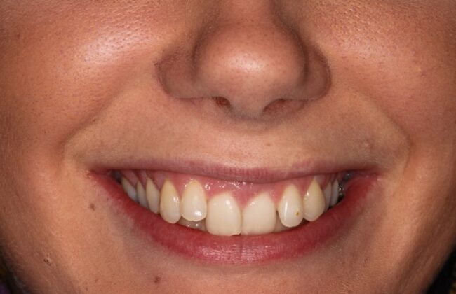Before (Teeth)