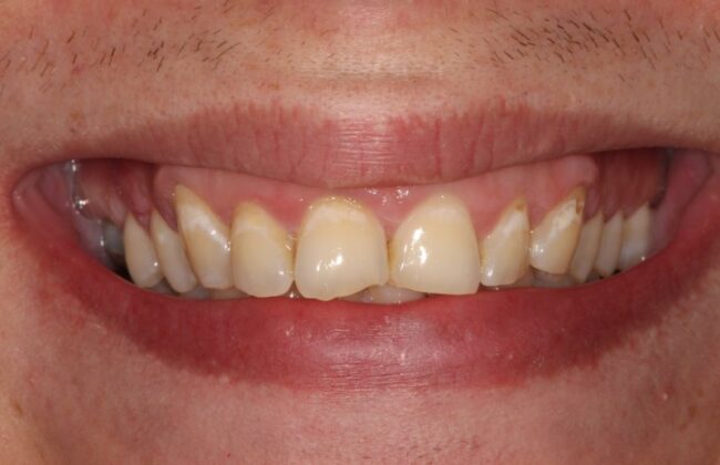 Before (Teeth)