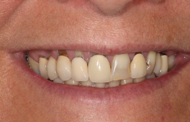 Before (Teeth)