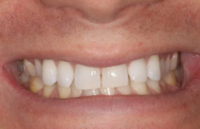 Before (Teeth)