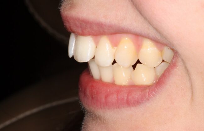 Before (Teeth)