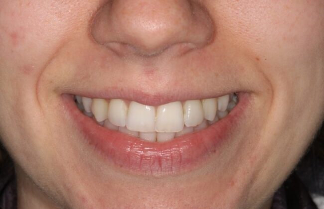 Before (Teeth)