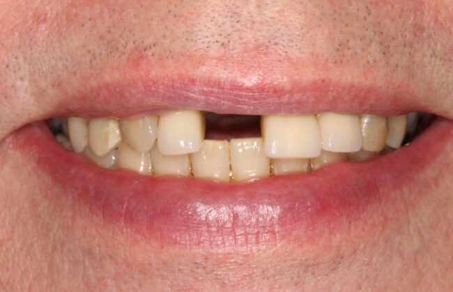Before (Teeth)