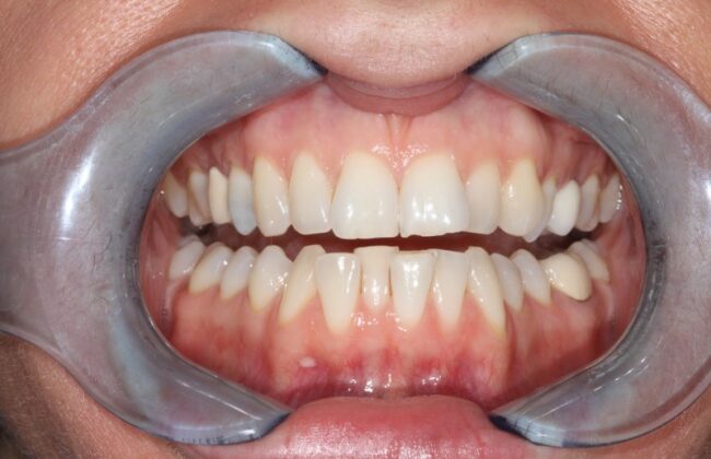 Before (Teeth)