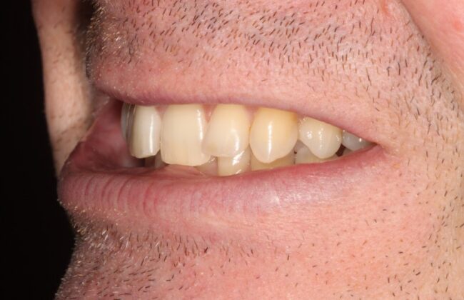 Before (Teeth)