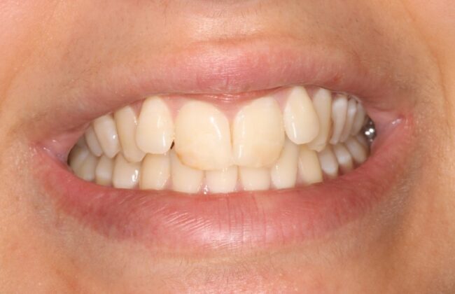 Before (Teeth)