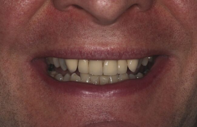 Before (Teeth)