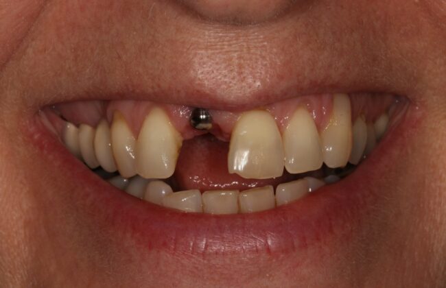 Before (Teeth)