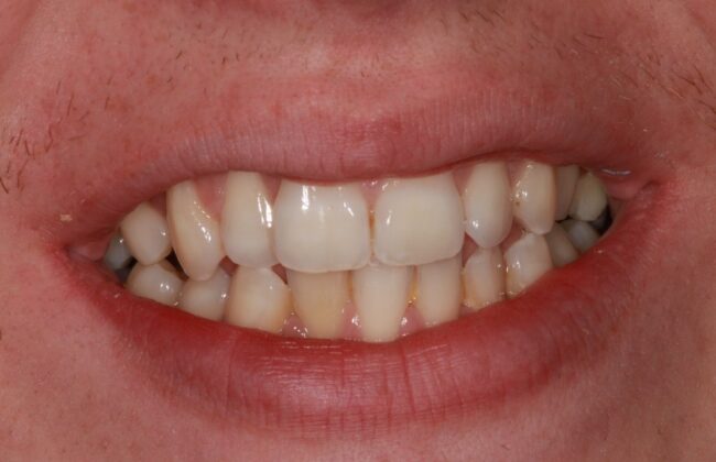 Before (Teeth)