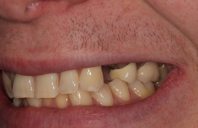 Before (Teeth)