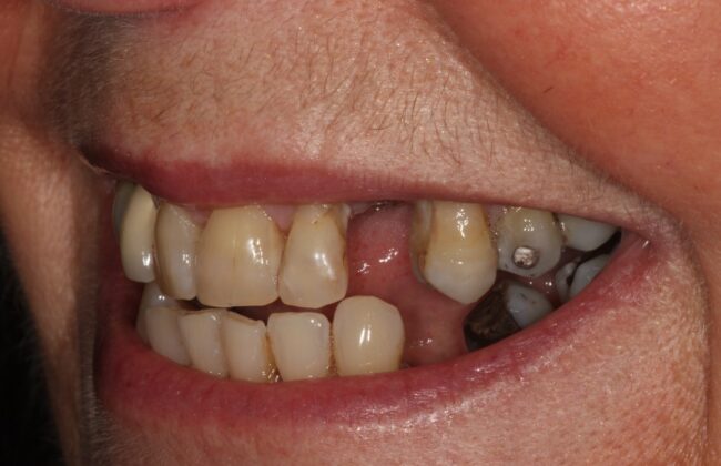 Before (Teeth)