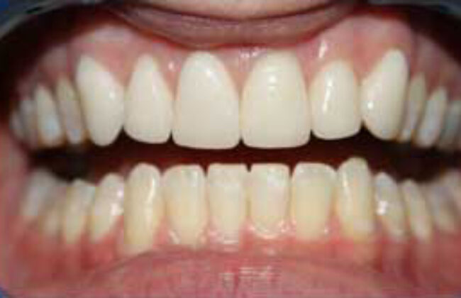 After (Teeth)